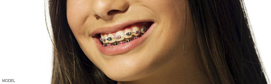 Dental Braces for Adults & Children, Brought to you by Los Angeles Orthodontist, Dr. Arleen Azar Mehr