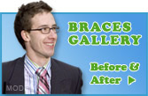 Braces Gallery
